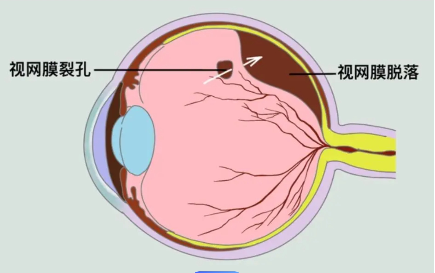 视网膜孔裂图片