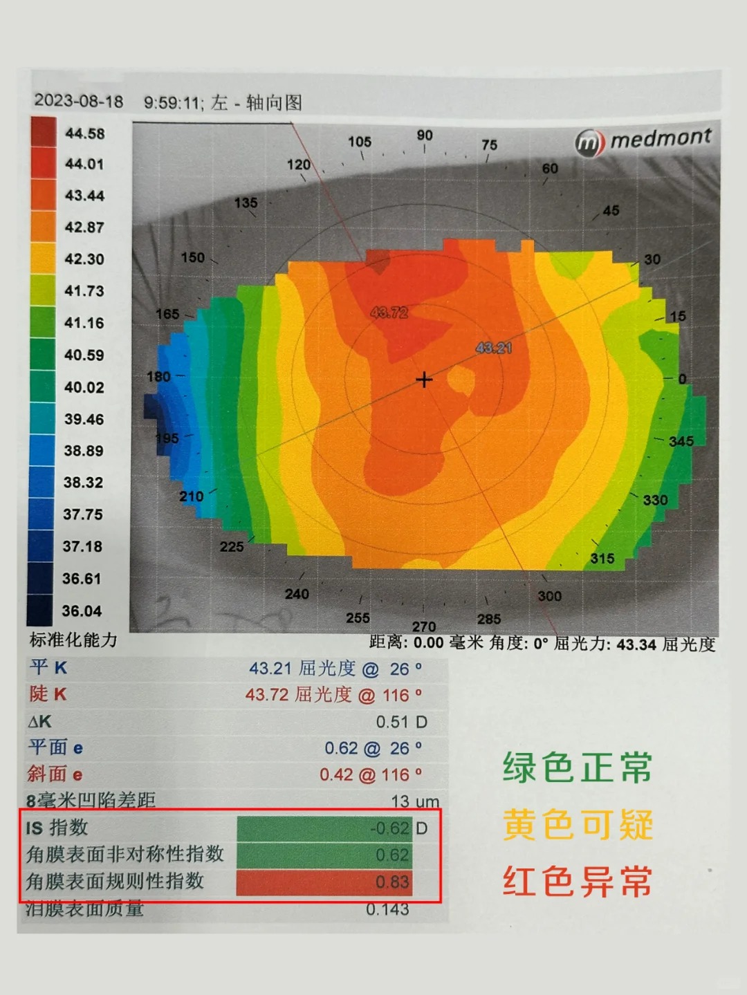 孩子角膜是否有特殊情况，就看这几个数值_1_小树眼科青少年近视防控_来自小红书网页版